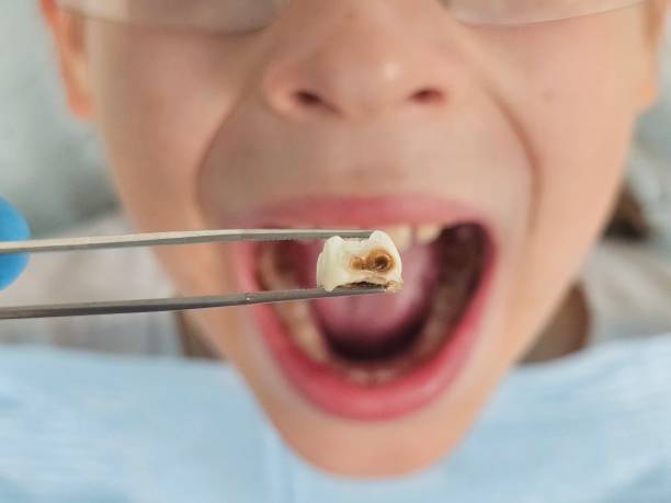Best Emergency Treatment for Dental Infections or Abscesses in Keyser, WV